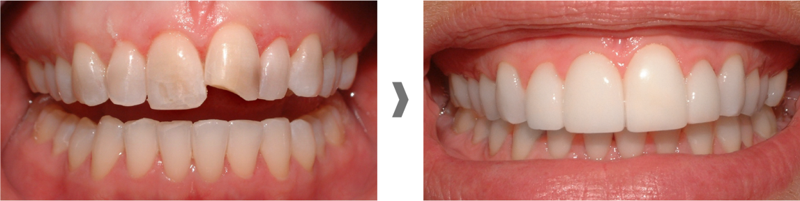 Carillas dentales sin rebajar el diente en Barberà