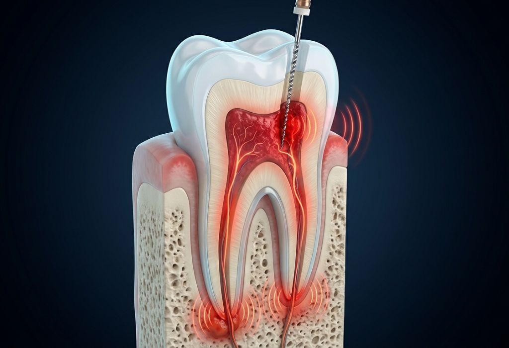 Muela con endodoncia que duele años después