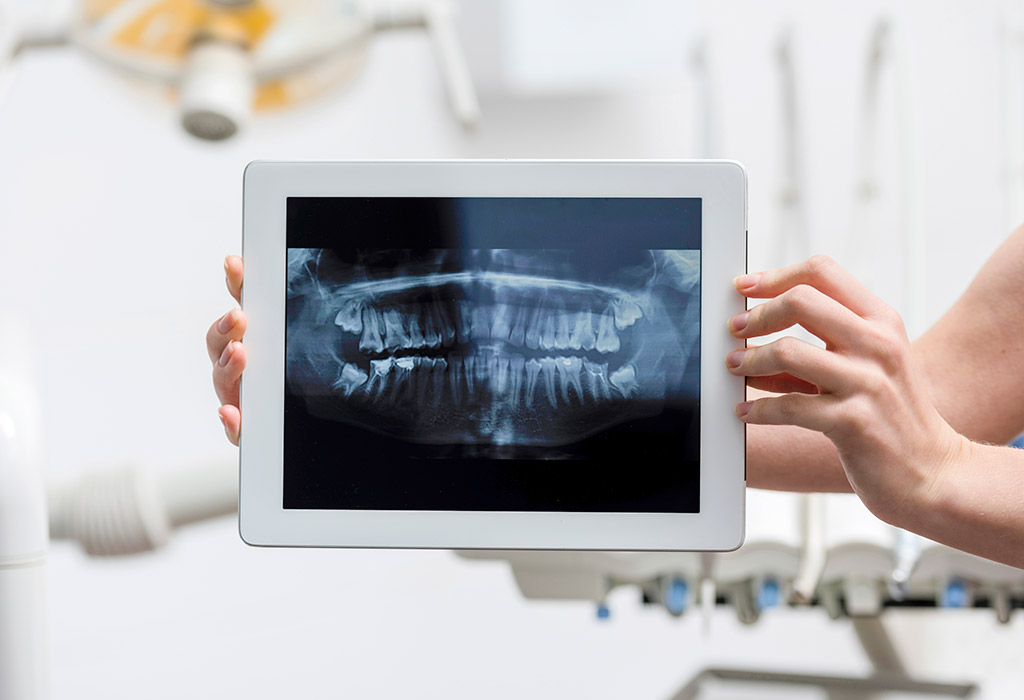 Implantes dentales de carga inmediata en Cerdanyola