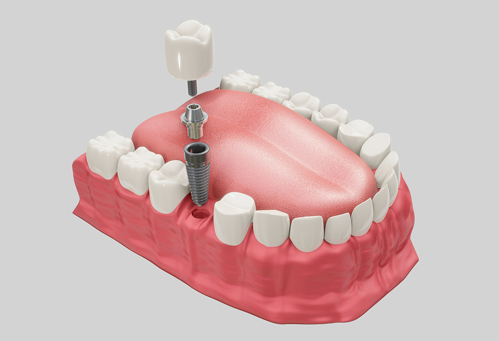 Implantes dentales de carga inmediata en Cerdanyola