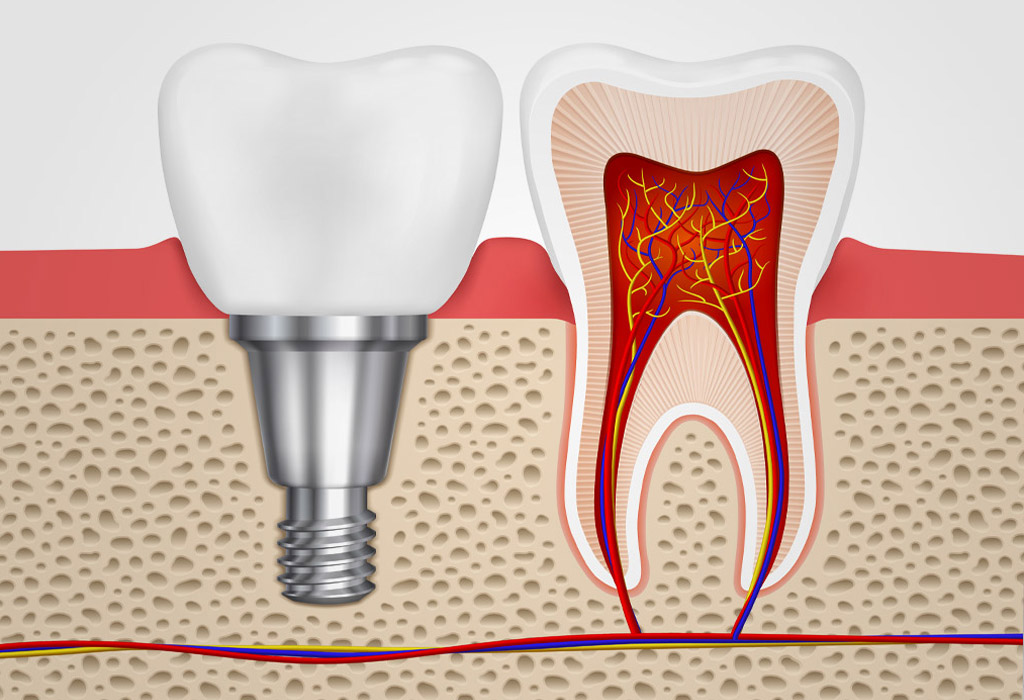 implantes dentales cortos 