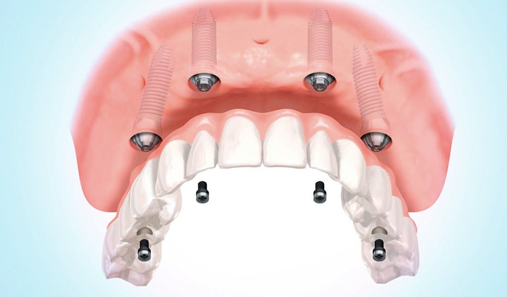 implantes dentales Barberà