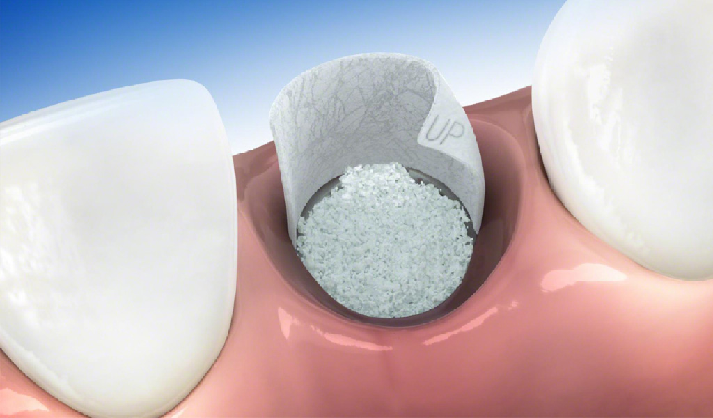 Implantes dentales en Badal-Barcelona