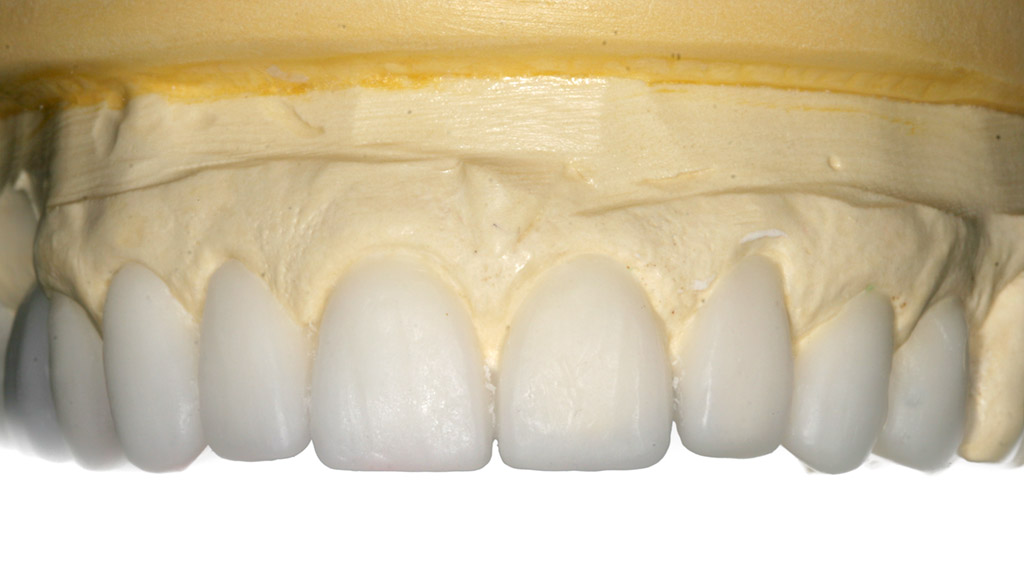 Carillas dentales sin rebajar el diente en Barberà